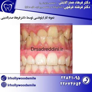 ارتودنسی دندان 2