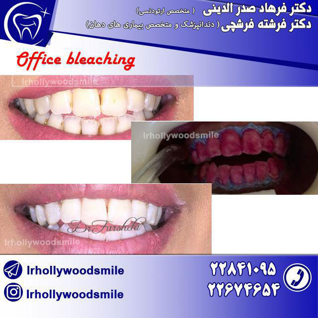 بلیچینگ دندان 1