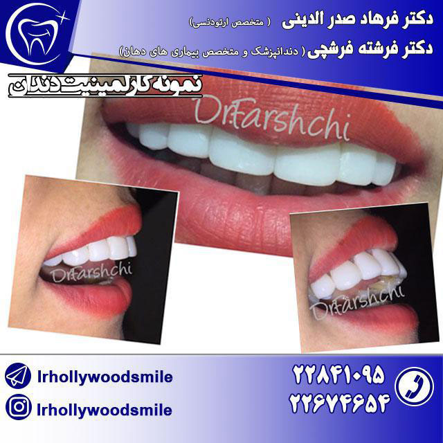 لامینیت دندان 1