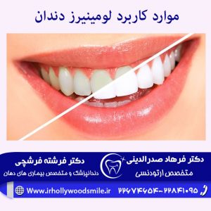 موارد کاربرد لومینیرز دندان