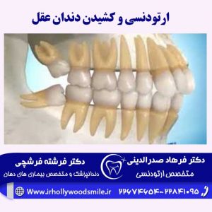 ارتودنسی دندان و کشیدن دندان عقل